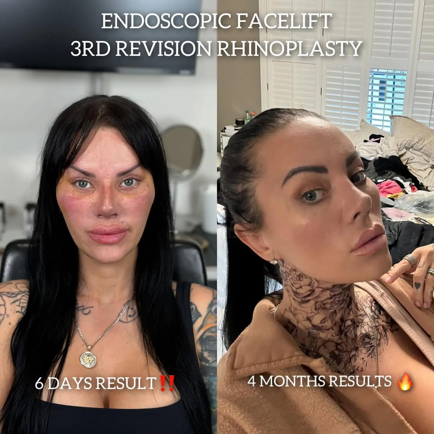 Fox Eyes Treatment - Before and After Image 1